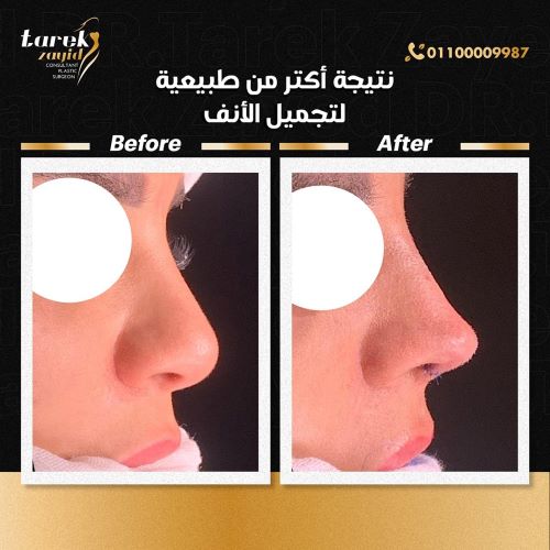 أنواع عمليات تجميل الأنف